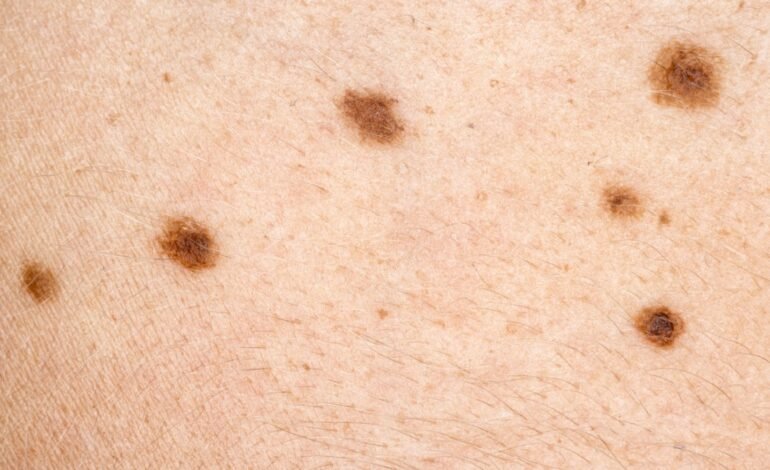 Dermatóloga advierte sobre el aumento del cáncer de piel