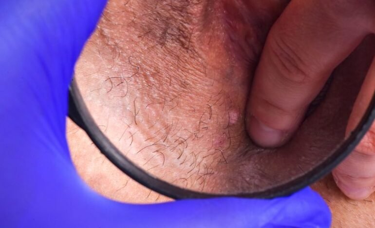 Una vacuna contra el herpes zóster podría estar reduciendo el riesgo de demencia, incluido el Alzheimer