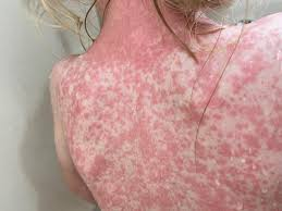 Sarampión en RD: un brote a la vista